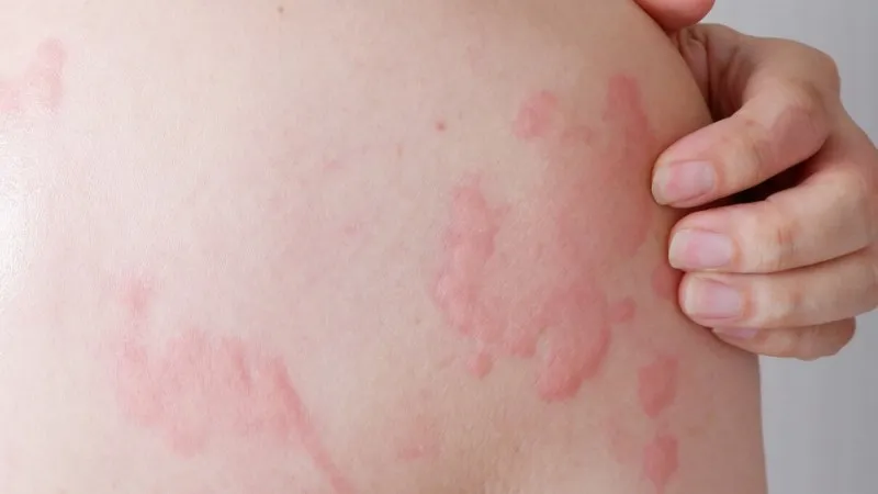 Dấu hiệu và cách chữa trị mề đay cấp tính