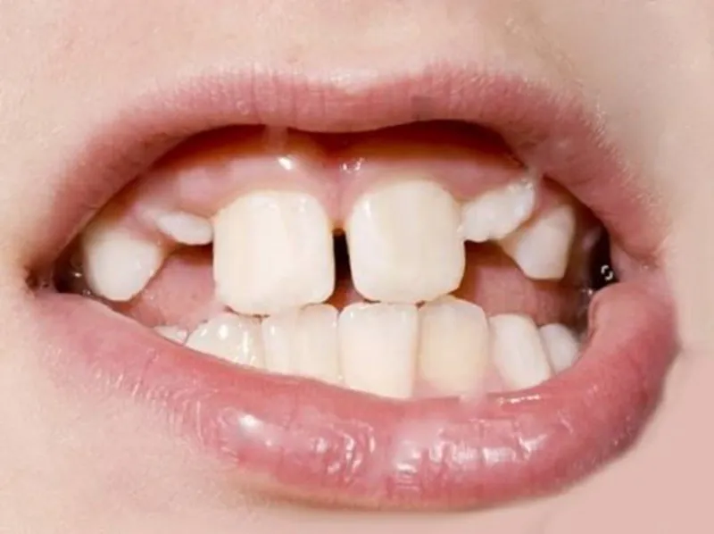 Nguy hiểm của việc tự nhổ răng sữa cho bé 5 tuổi tại nhà
