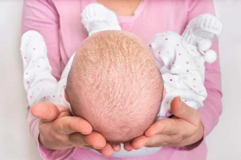 Bệnh vẩy nến ở trẻ sơ sinh: tổn thương da và cách chăm sóc đúng cách