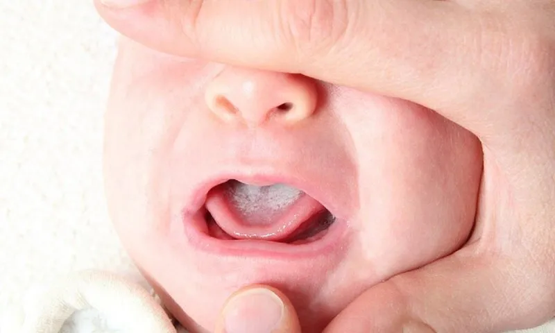 Nấm miệng candida ở trẻ em: nguyên nhân và triệu chứng