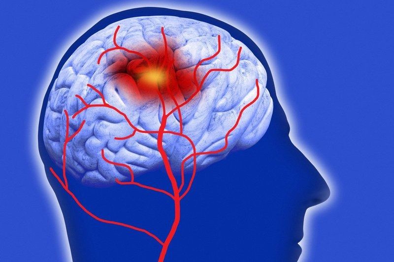 Hội chứng não cấp: các triệu chứng, chẩn đoán và điều trị