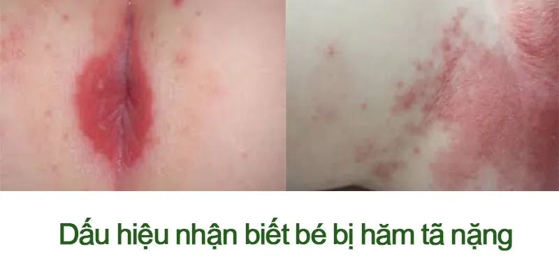 Hăm tã nặng ở trẻ nhỏ: nguyên nhân và cách chữa trị hiệu quả
