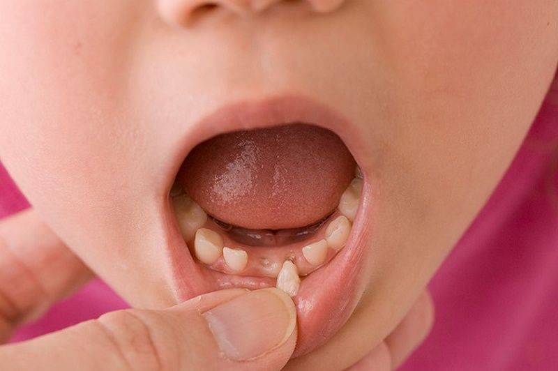 Nhổ răng sữa còn chân: nguy hiểm và cách khắc phục