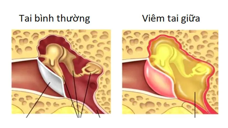 Bước vào lúc nước vào tai: triệu chứng và tác động