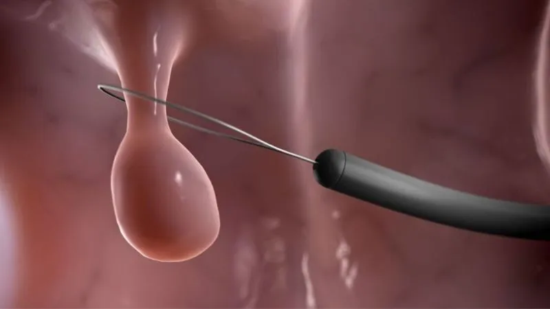 Polyp loạn sản đại tràng: nguyên nhân và cách điều trị