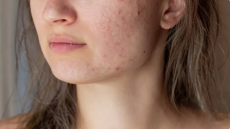 Ghẻ demodex ở người có thể lây truyền như thế nào?