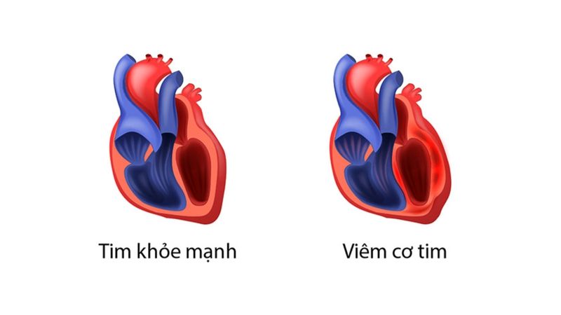 Bệnh quai bị ở trẻ em: nguyên nhân, triệu chứng và biến chứng