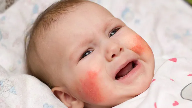 Sốc phản vệ ở trẻ em: các triệu chứng và cách xử trí