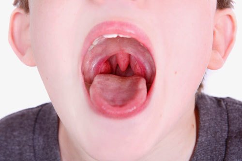 Viêm họng ở trẻ - Những dấu hiệu, cách phòng tránh lúc giao mùa