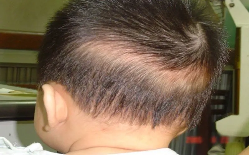Tình trạng rụng tóc máu ở trẻ sơ sinh: có nên lo lắng?