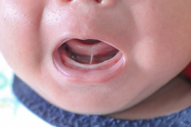 Dính thắng lưỡi ở trẻ, cách nhận biết và điều trị