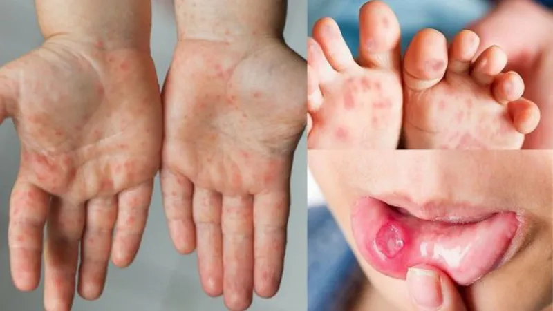 Trẻ phát ban đỏ sau 3 ngày sốt: nguyên nhân, bệnh lý và cách chăm sóc