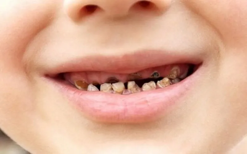Răng sữa bị đen, xỉn màu: nguyên nhân và cách khắc phục
