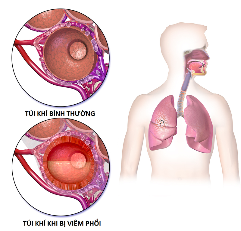 Chẩn đoán viêm phổi: triệu chứng, xét nghiệm và phương pháp điều trị