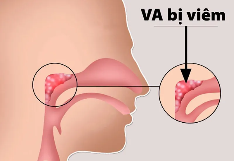 Nạo va bằng dao plasma: phương pháp hiện đại để điều trị viêm va