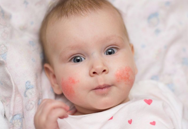 Trị chàm sữa bằng lá ổi - phương pháp dân gian an toàn và hiệu quả