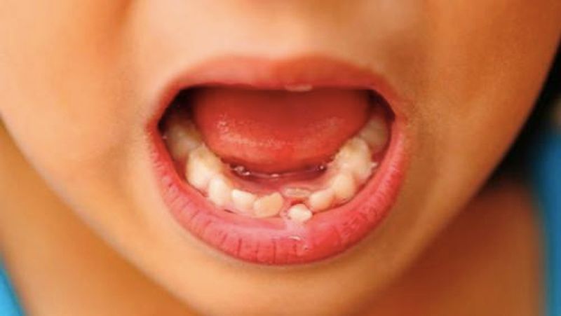 Nguy hiểm của việc tự nhổ răng sữa cho bé 5 tuổi tại nhà