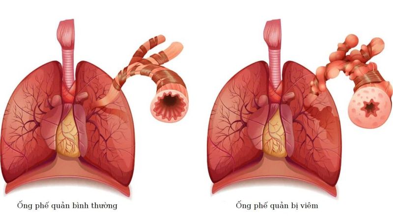 Bệnh hen phế quản: nguyên nhân, triệu chứng và phác đồ điều trị