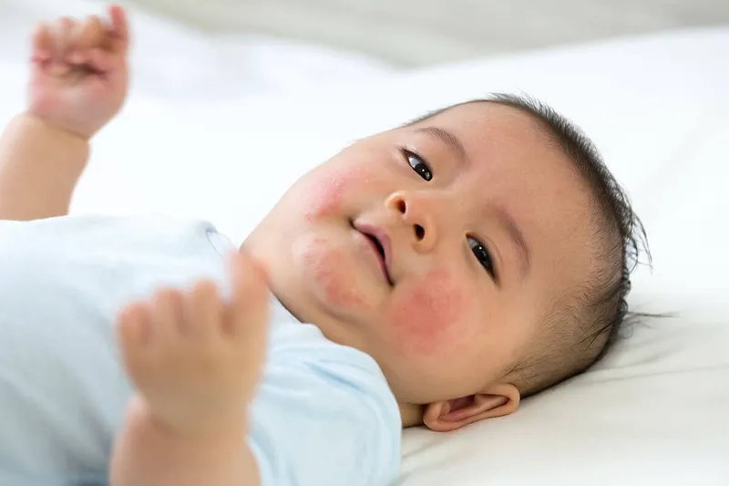 Viêm da mủ ở trẻ sơ sinh: nguyên nhân, triệu chứng và cách điều trị