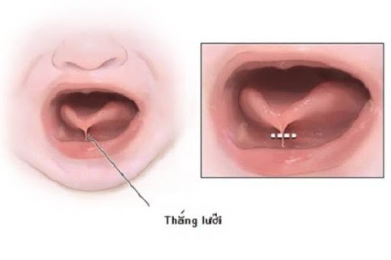 Phẫu thuật cắt dính thắng lưỡi: giải pháp đơn giản cho trẻ