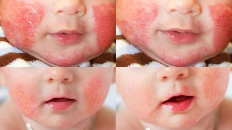 Trị chàm sữa bằng lá trà xanh có hiệu quả thật không?