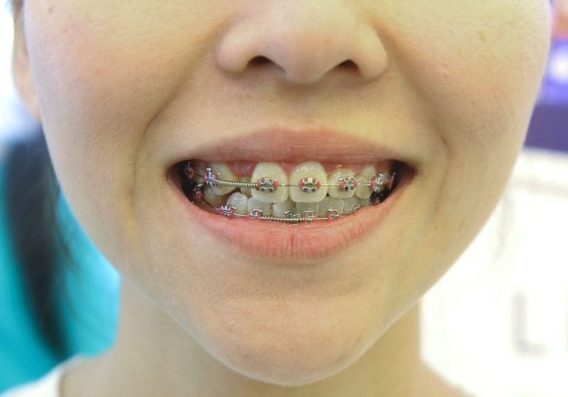 Nguyên nhân và cách phòng ngừa lệch mặt khi niềng răng