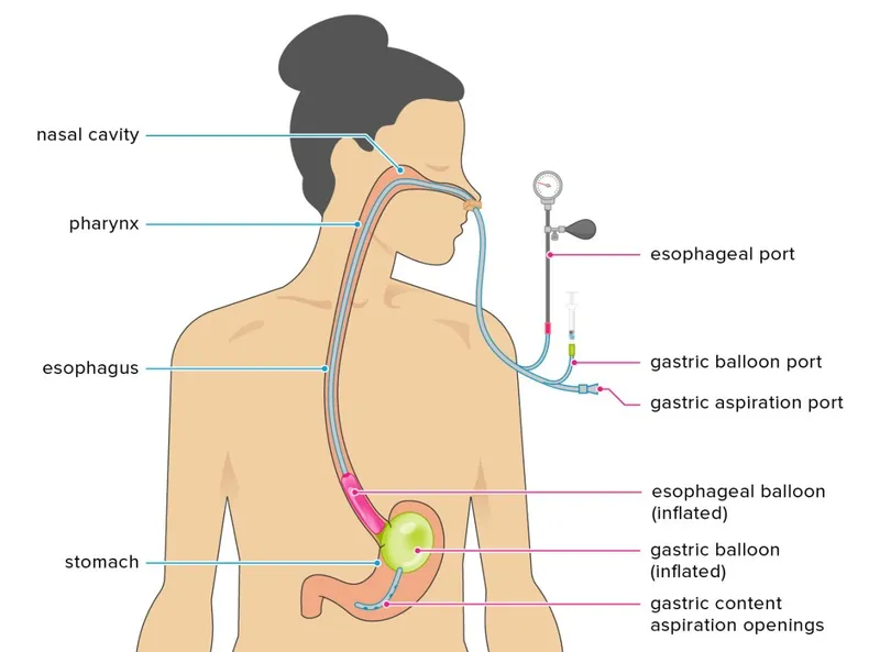 Đặt ống thông dạ dày cho trẻ sơ sinh: quan trọng và cần thiết