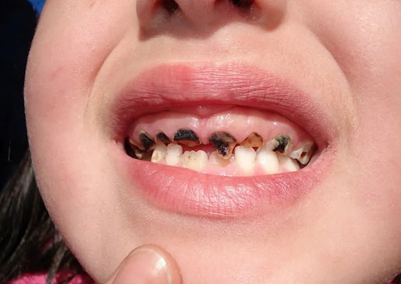 Răng sữa bị đen, xỉn màu: nguyên nhân và cách khắc phục