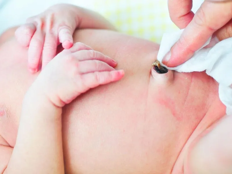 Rốn trẻ sơ sinh bị ướt: nguyên nhân, cách xử lý và chăm sóc