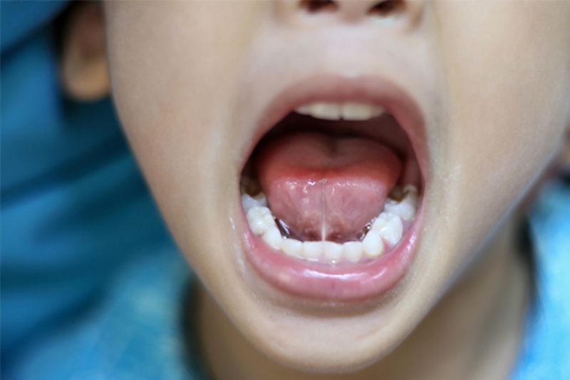 Tìm hiểu về tật dính thắng lưỡi ở trẻ sơ sinh và cách điều trị