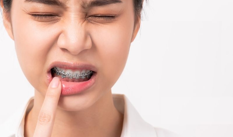 Lợi trùm khi niềng răng: nguyên nhân, dấu hiệu và cách khắc phục