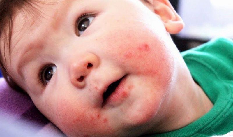 Bệnh dị ứng ở trẻ em: nguyên nhân và cách chữa trị hiệu quả