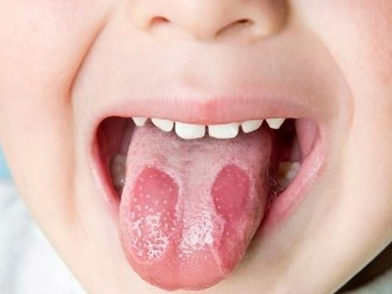 Nấm miệng và nhiệt miệng: nguyên nhân, triệu chứng và cách chăm sóc