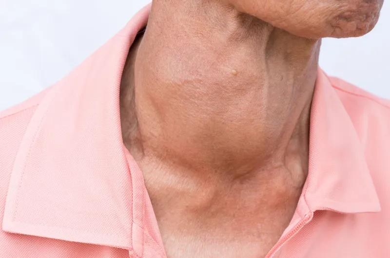 Bướu giáp là gì và cách chữa trị