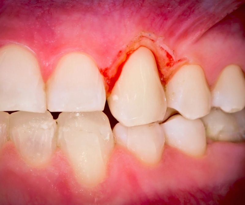 Răng mọc chồi: tình trạng, tác động và cách khắc phục