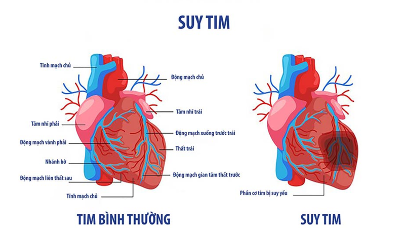 Bệnh suy tim: nguyên nhân, triệu chứng và điều trị