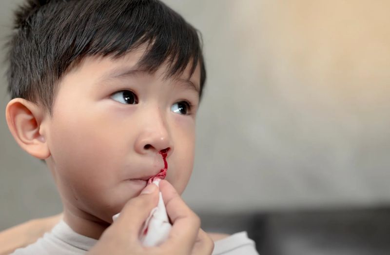 Trẻ bị chảy máu mũi 1 bên khi ngủ: nguyên nhân, cách xử lý