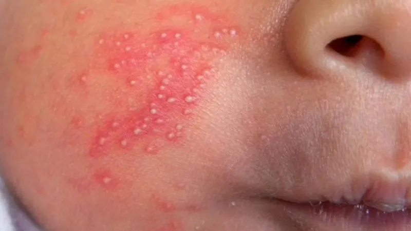 Viêm da mủ ở trẻ sơ sinh: nguyên nhân, triệu chứng và cách điều trị