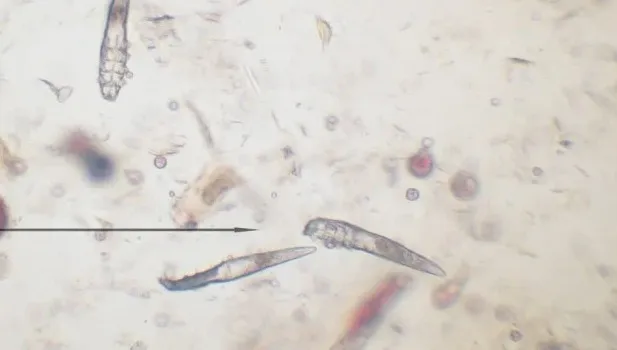 Ghẻ demodex ở người có thể lây truyền như thế nào?