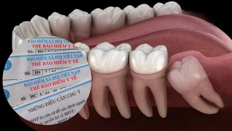 Faq về nhổ răng khôn