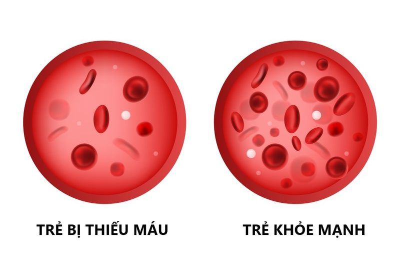 Thiếu máu ở trẻ em: nguyên nhân và cách phòng ngừa