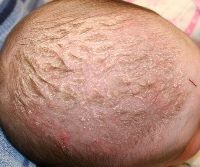 Bệnh vảy nến ở trẻ em: triệu chứng, điều trị và các phương pháp chăm sóc