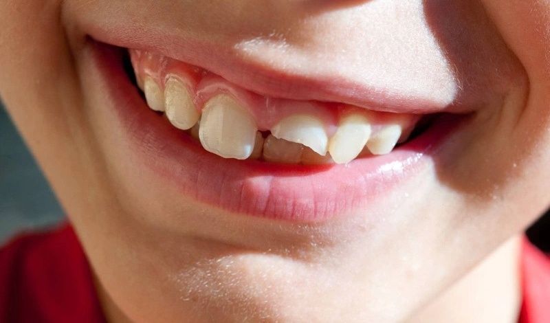 3 phương pháp phục hồi răng bị mẻ tại nhà mà bạn nên biết