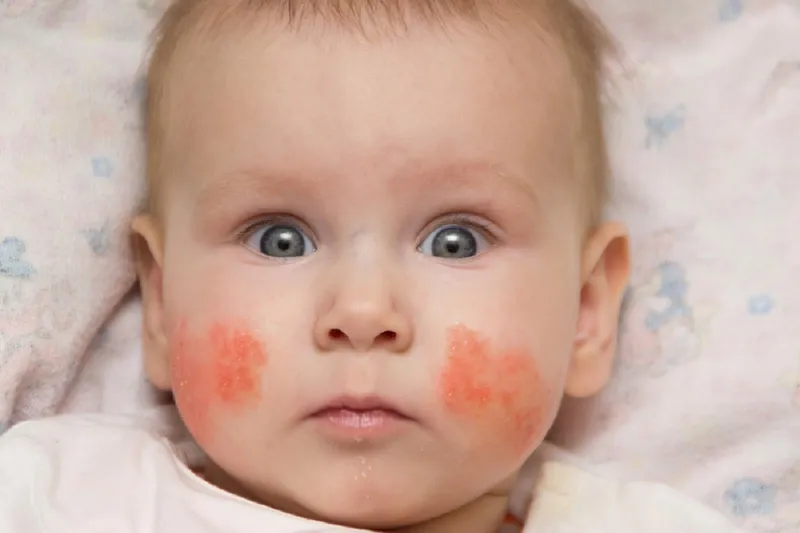 3 cách trị chàm sữa theo dân gian hiệu quả và an toàn