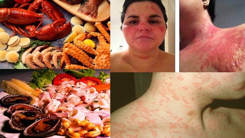 Dị ứng động vật có vỏ: triệu chứng, nguyên nhân và cách phòng ngừa