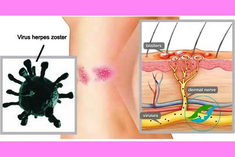 Nhiễm trùng da ở trẻ sơ sinh: nguyên nhân, biểu hiện và cách điều trị