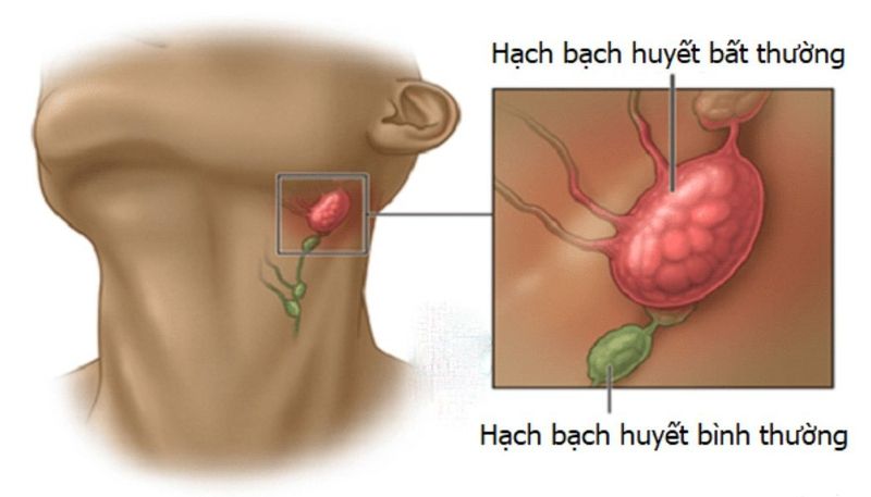 Ung thư hạch bạch huyết: hiểu về căn bệnh và phương pháp điều trị