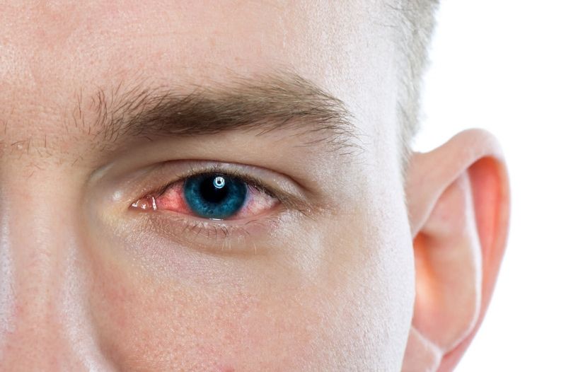 Nguyên nhân gây bệnh đau mắt đỏ và cách xử lý đúng cách