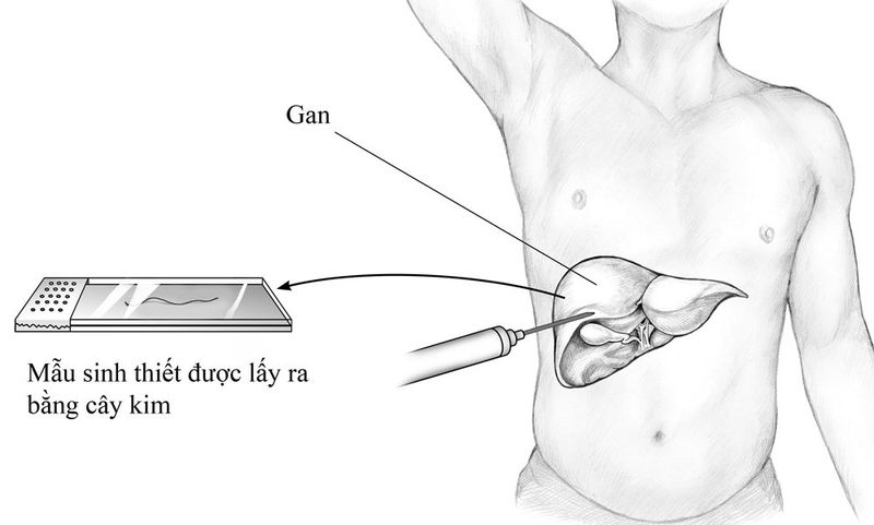 Sinh thiết đường mật qua da dưới x quang tăng sáng