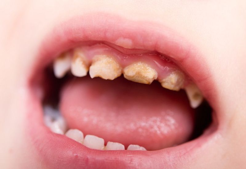 Tình trạng răng sữa của bé bị mủn: nguyên nhân và cách khắc phục